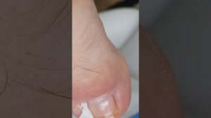 Вросший ноготь. Как достать шип?