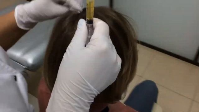 Плазмолифтинг волосистой части головы смотреть онлайн