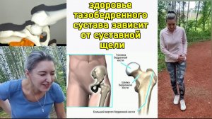 Как избежать деградации и развала тазобедренных суставов? Научитесь сохранять суставную щель