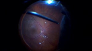 Витреоретинальная хирургия на R-Evolution (Optikon, Италия)