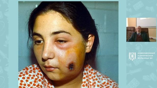 Сибирская язва. Лекция Никифорова Владимира Владимировича в ИКБ №1