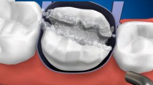 medikastom Ортопедическая стоматология   Лечение кариеса и пломбирование полости композитными матер