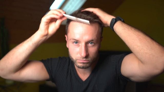 I started with Oral Minoxidil for Hair Regrowth! 2 Month Update смотреть онлайн