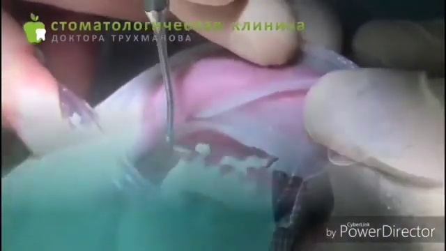 Протезирование на имплантах с использованием материалов оксида циркония смотреть онлайн