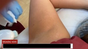 Фотоэпиляция