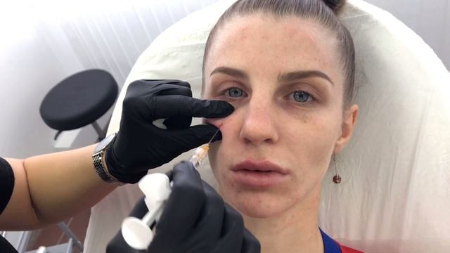 Коррекция носослезной борозды смотреть онлайн