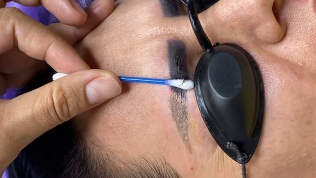 Лазер билан татуажни ўчириш смотреть онлайн