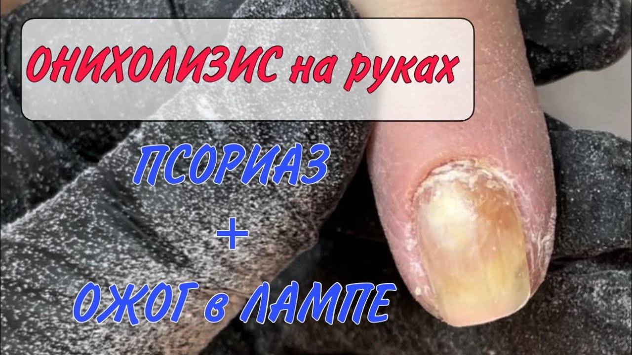 🔥ОЖОГ в лампе _ ПСОРИАЗ ногтей _ ОНИХОЛИЗИС