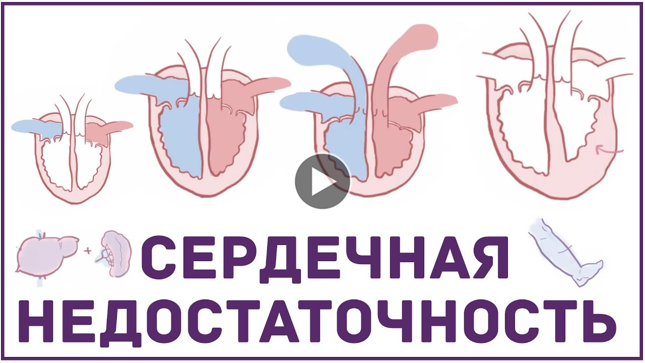 СЕРДЕЧНАЯ НЕДОСТАТОЧНОСТЬ - ПРИЧНЫ СИМПТОМЫ ЛЕЧЕНИЕ.mp4