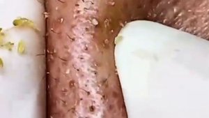 MOST SATISFYING BLACKHEAD PIMPLE POPPER VIDEO