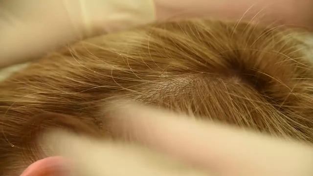 Мезотерапия волосистой части головы / Head skin mesotherapy