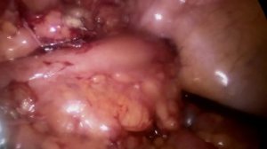 Закрытие одноствольной колостомы