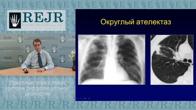 Одиночные очаги  в легких: критерии дифференциальной диагностики