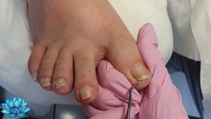 Вросший ноготь. Коррекция скрученных ногтей.