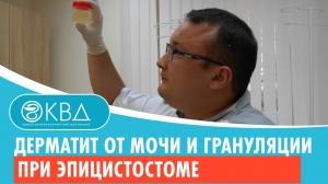 ? Дерматит от мочи и грануляции при эпицистостоме. Клинический случай №523