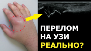 Как выглядит ПЕРЕЛОМ кости на УЗИ?