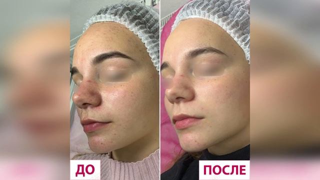 Результаты лечение акне а Лазерхауз смотреть онлайн