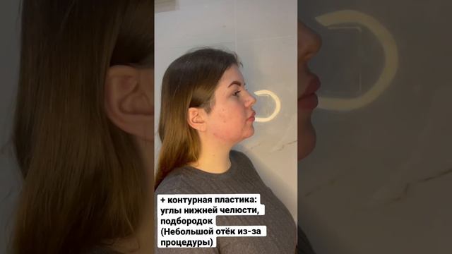 Контурная пластика, full face | tg: @dr_abasheva #липолитики  #топ #тренды