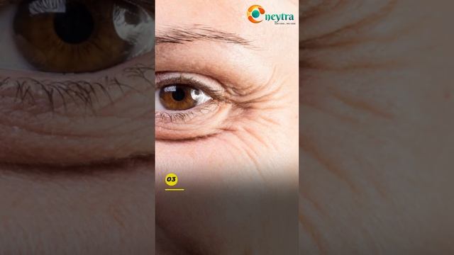 Botox Treatment to get rid of signs of Aging | Dr. Priyanka Singh | NEYTRA Eye Care Center in Delhi