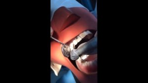 Методика препарировани 4 класса по Блэку