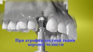 Импланты Straumann для сложных случаев в "Космос Плюс"