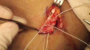 Single Incision Distal Biceps Repair Using the Modified Tension Slide Suture Technique