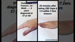 20 min after CBD ! Parkinson’s Tremor
Снятие тремора КБД маслом CBD при Болезнь Паркинсона