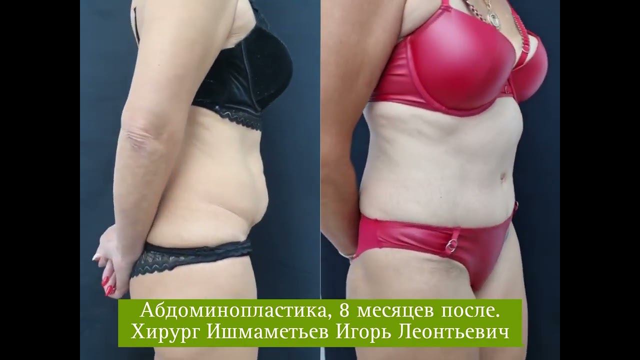 Пластическая хирургия. Абдоминопластика
