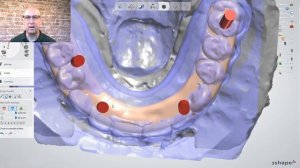 3Shape Crystal Ultra Design Tutorial [The All on 4 Implant Hybrid  Bar Solution]