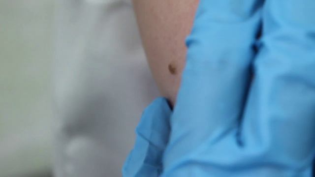 Удаление кератомы криодеструкцией