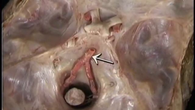 Кровоснабжение головного мозга 1 Trimmed смотреть онлайн