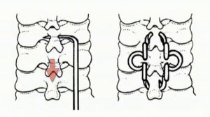 Вывихи нижних шейных позвонков (анатомия - диагностика - лечение)