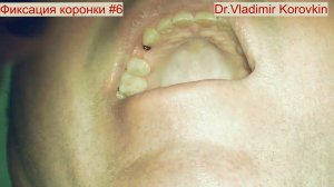 Фиксация металлокерамической коронки на импланте 14. Кейс #6.