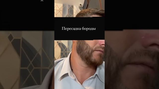 Пересадка волос на бороду . В Москве и в Стамбуле | результат 4,5 месяца | Халил Коч