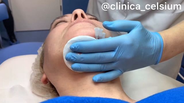 Нитевой лифтинг. Процедура нитевого лифтинга. Подтянуть лицо смотреть онлайн