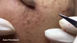 УГРИ ДАВЛЮ Как избавится от прыщей! ЧЕРНЫХ ТОЧЕК