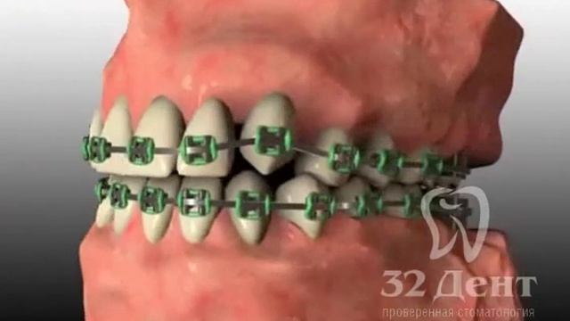 Ортодонтия. Как происходит процесс исправление прикуса смотреть онлайн