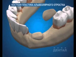 Костная пластика