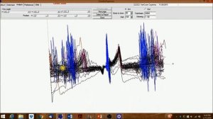 DEXTRONIX- How to analyze an ECG using CardioExplorer