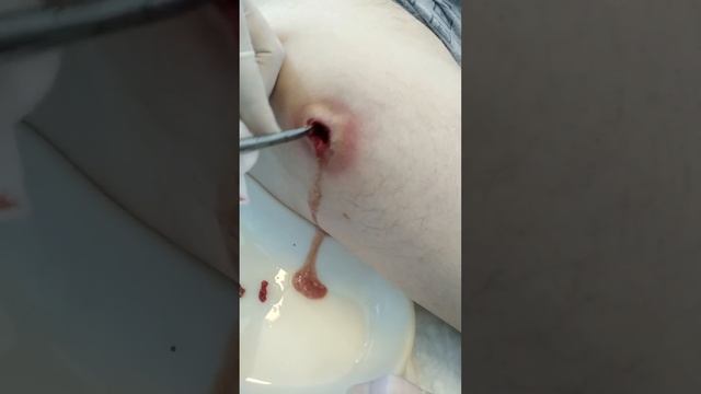 SUPER PIMPLE!!! Большой прыщ!!! смотреть онлайн