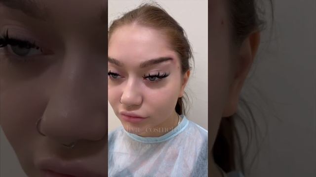 Нитевая подтяжка бровей #shotrs