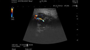 Заболевание околоушной слюнной железы