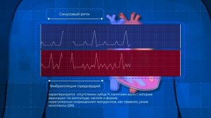 Фибрилляция предсердий и инсульт