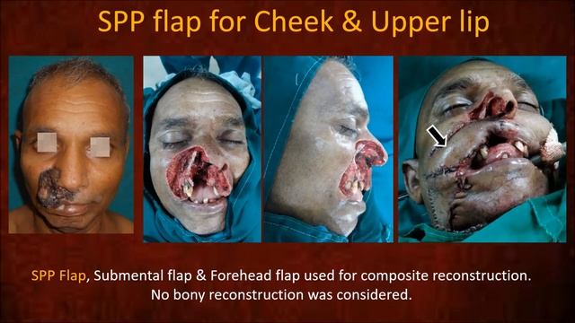 Propeller flaps for the face. смотреть онлайн