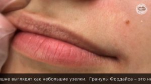 Гранулы Фордайса на губах