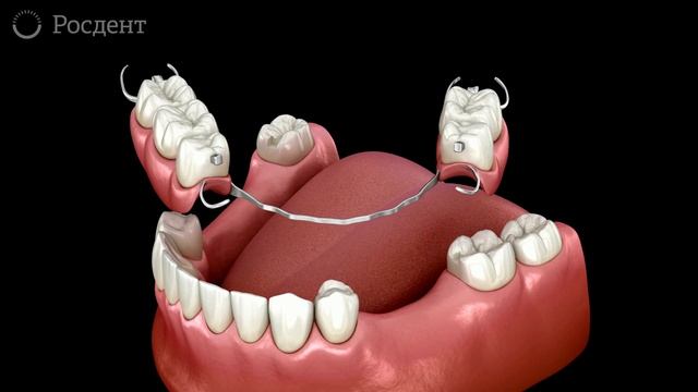 Бюгельный протез на замковых конструкциях