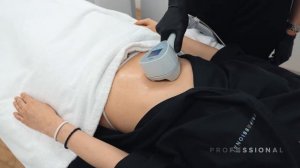 Exilis Ultra 360