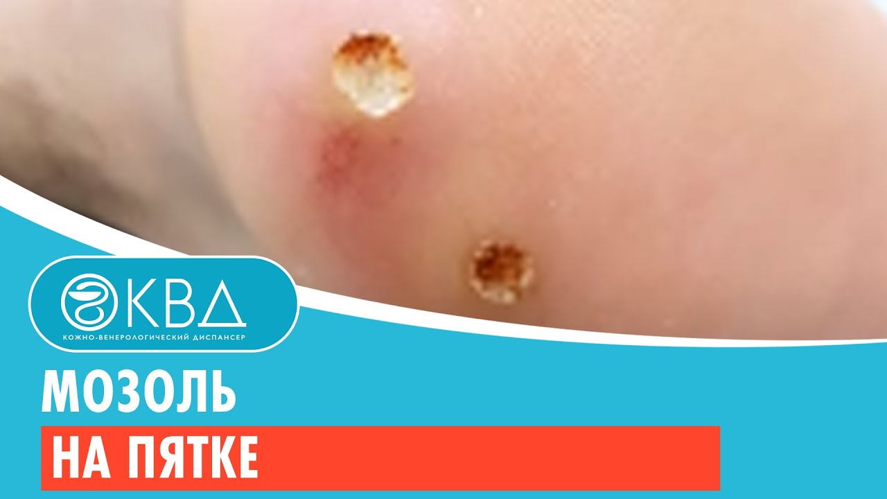 Мозоль на пятке. Клинический случай №32