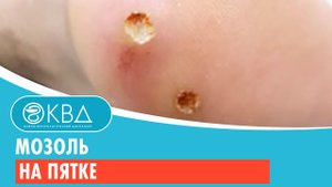 Мозоль на пятке. Клинический случай №32