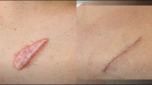 Почему на месте раны остается шрам?